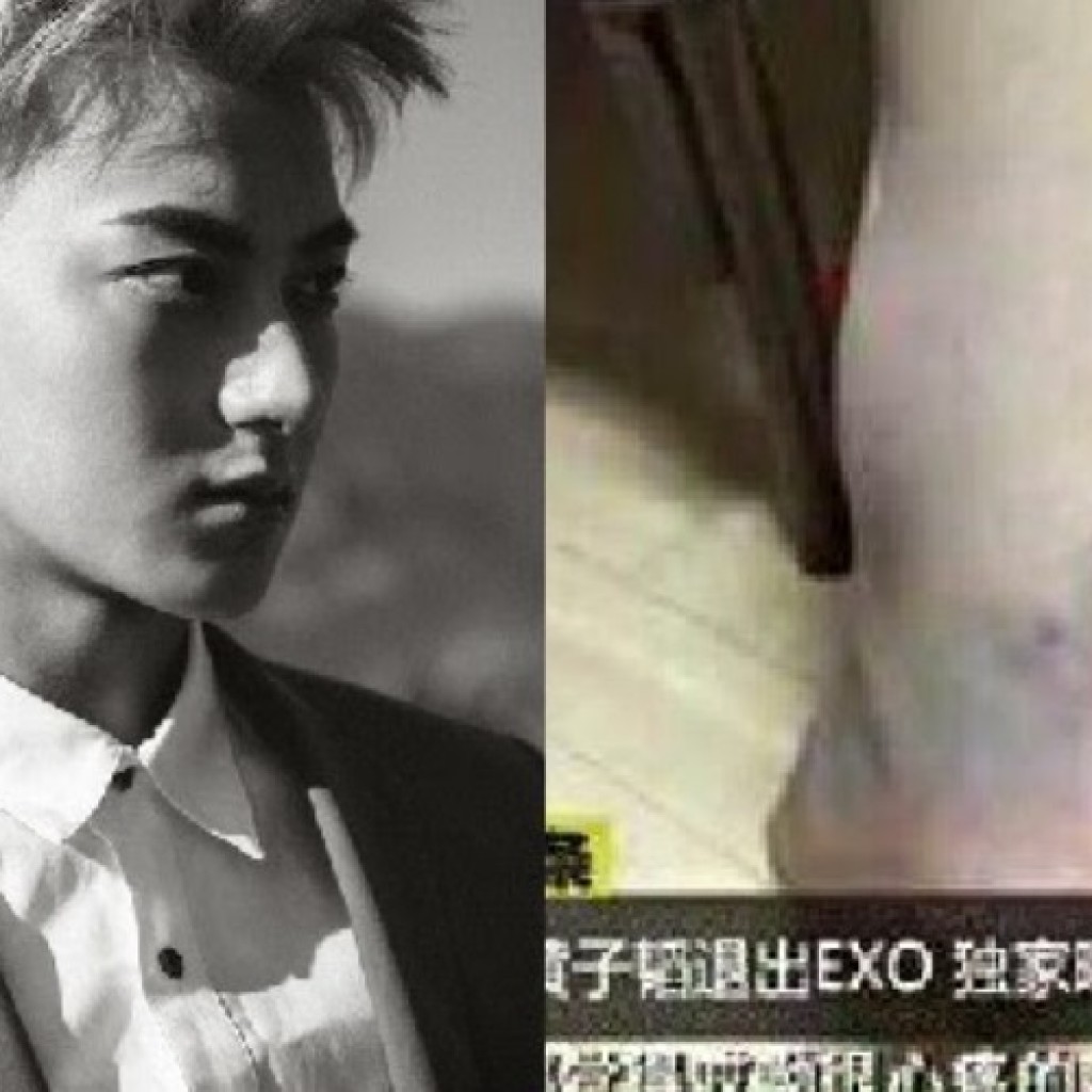 Cedera kaki Tao EXO