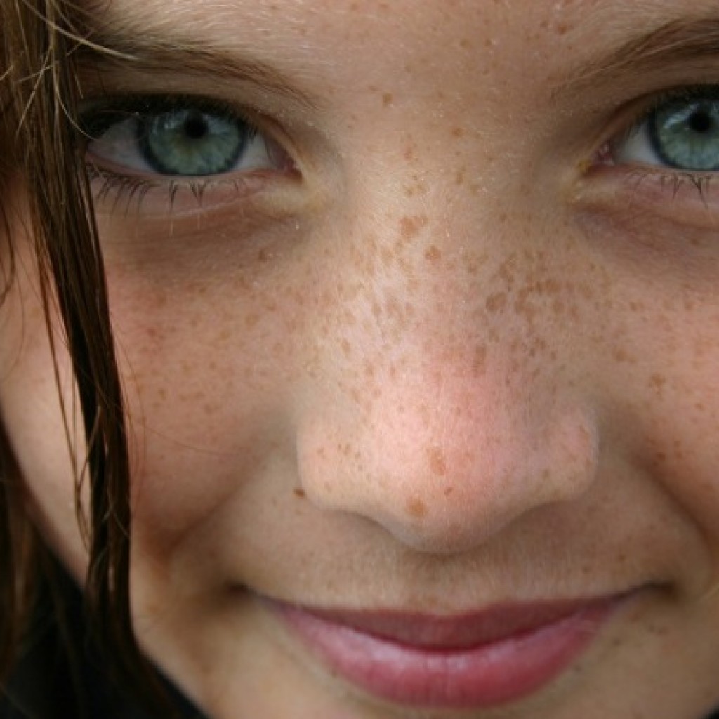 Apa Sih Bedanya Flek Freckles Dan Hyperpigmentasi