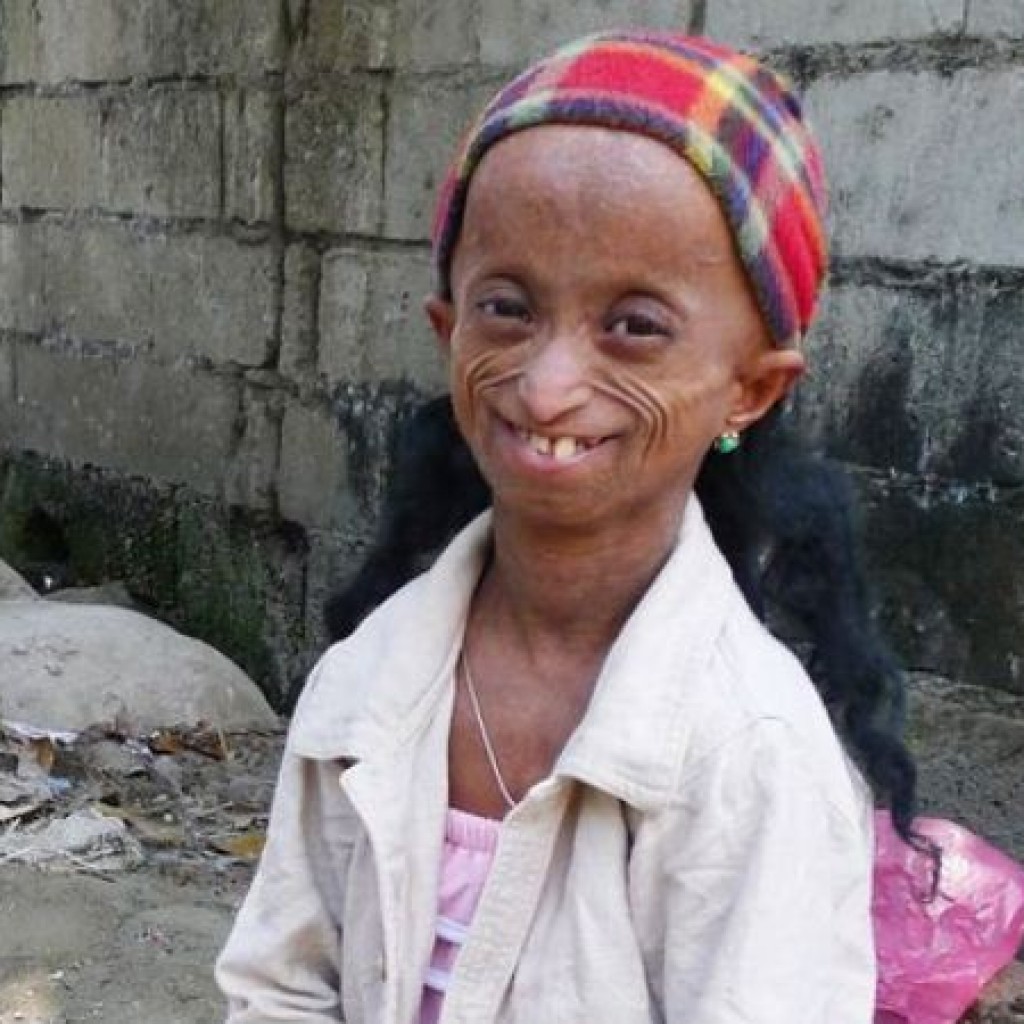 Rochelle Pondare Progeria