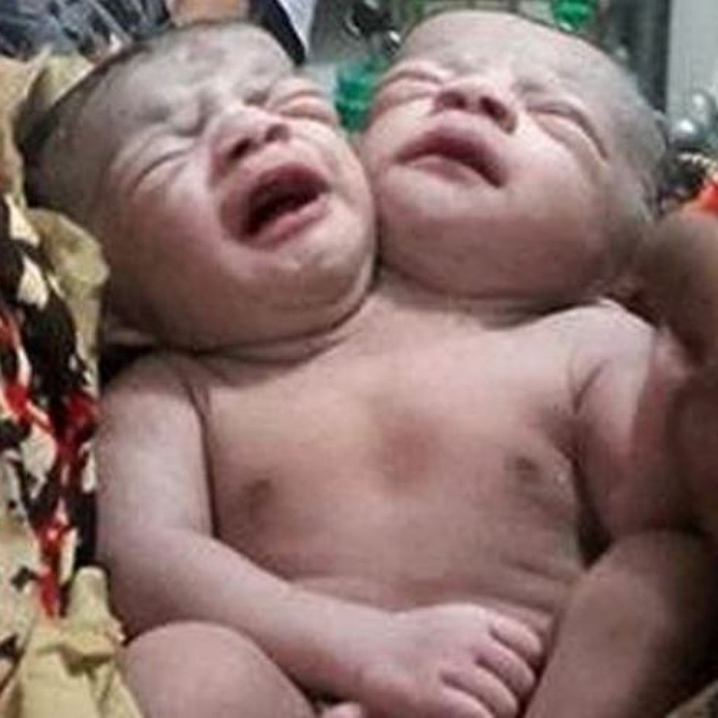 Bayi dua kepala di Bangladesh