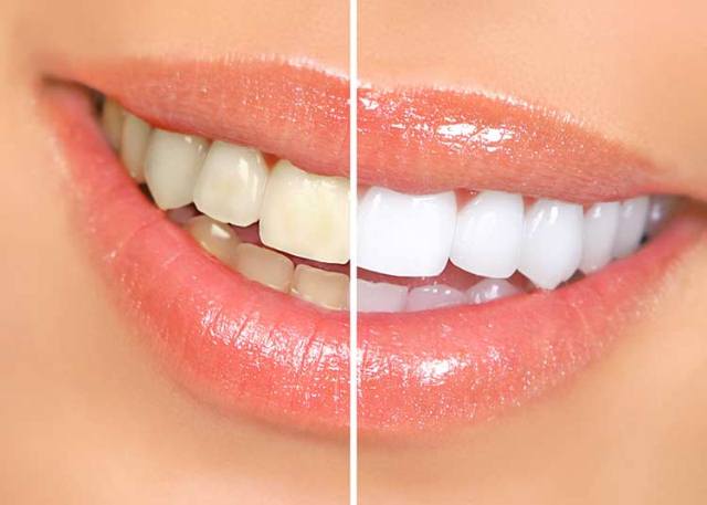 2 Kitchen Ingredients Can Whiten Your Teeth In 2 Days