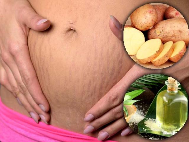 Potato And Castor Oil Skin Pack To Reduce Stretch Marks
