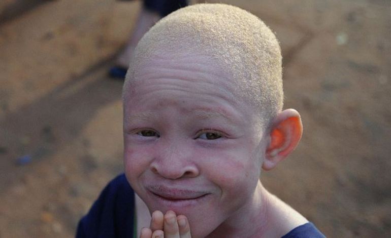 Warga Albino Afrika