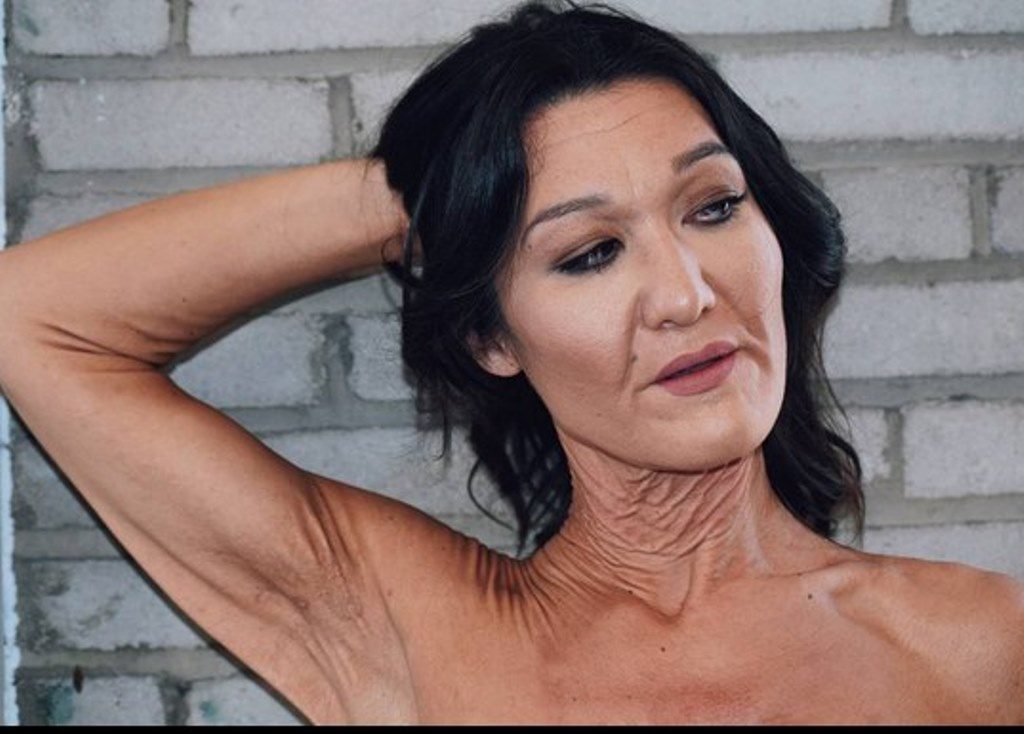 Punya Kelainan Kulit Langka Wanita 26 Tahun Ini Keriput Seumur Hidup