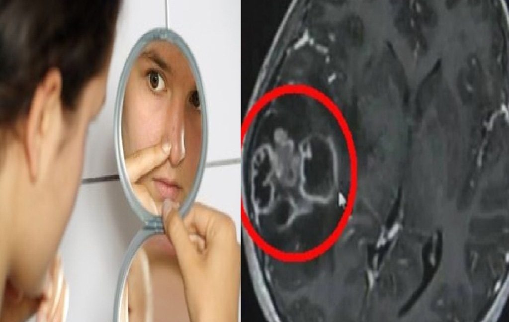 Bersihkan Komedo dengan Cara yang Salah Gadis Ini Mengalami Infeksi Otak