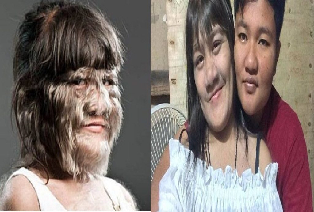 Natty Wanita Dengan Muka Penuh Bulu Kini Sudah Mulus Setelah Menikah