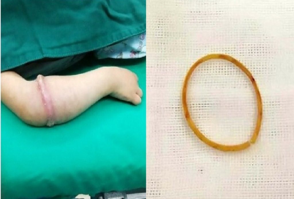 Dipakai Selama 6 Bulan Terus Menerus Karet Gelang Masuk Ke Dalam Tangan Bocah 4 Tahun Ini