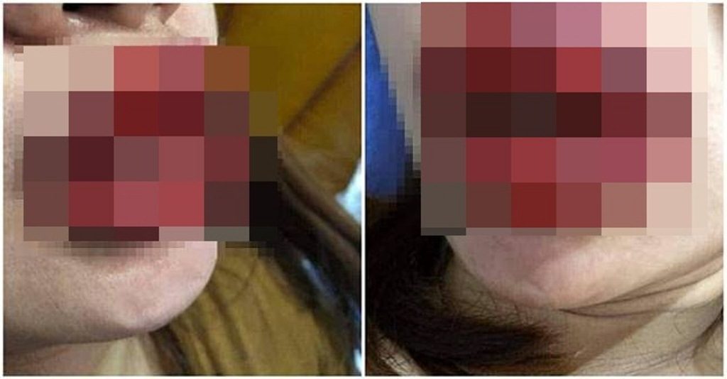 Waspada Pakai Lipstik Palsu Tiga Hari Berturut Turut Bibir Wanita ini Berubah Mengerikan