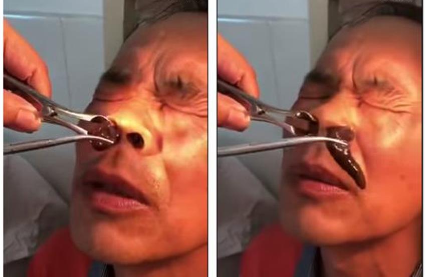 Sering Mimisan Pria ini Kaget saat Dokter Keluarkan Benda Asing dari Dalam Hidung