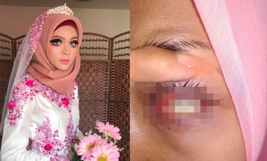 Pakai Softlens Sewaan di Hari Pernikahan Nasib Pengantin Wanita ini Berakhir Tragis