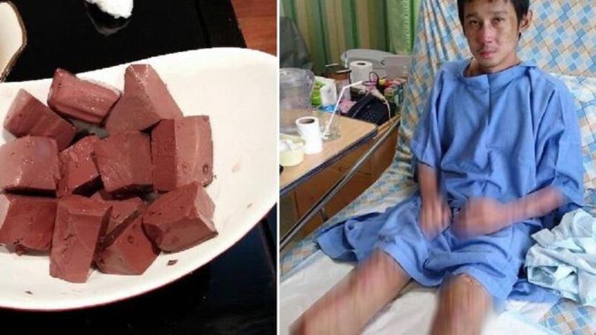 Akibat Makan Darah Babi, Kedua Kaki Pria ini Terpaksa Harus di Amputasi Akibat Makan Darah Babi Kedua Kaki Pria ini Terpaksa Harus di Amputasi