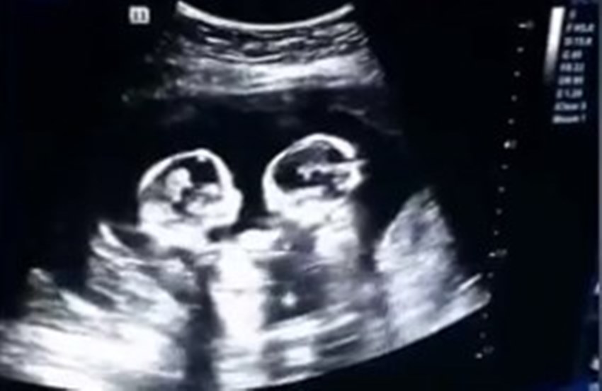 Heboh Foto USG Bayi Kembar Adu Jotos dalam Perut Sang Ibu