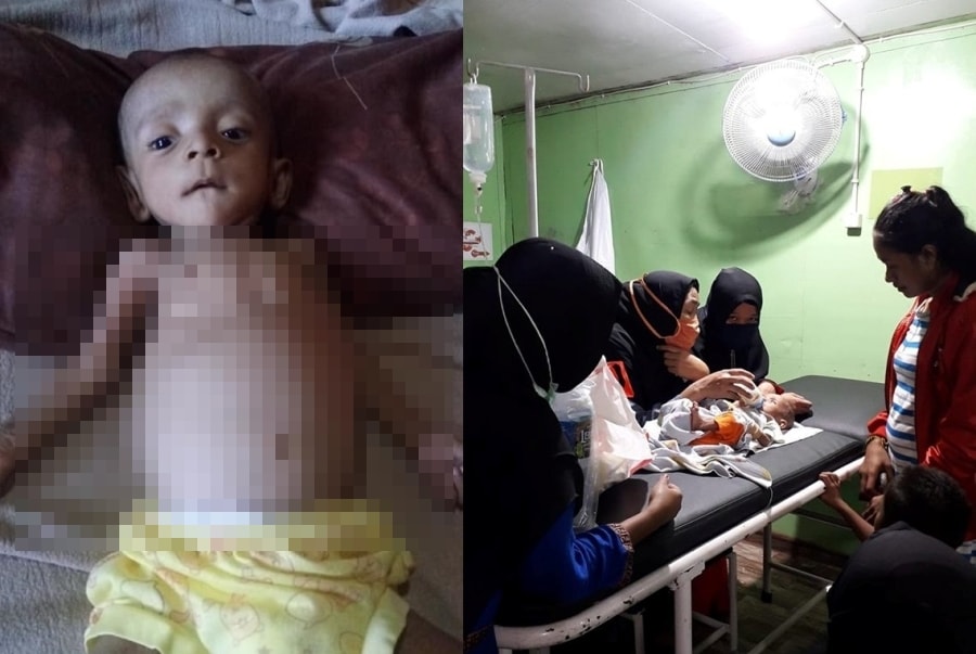 Bapak Pergi Entah Kemana Anak Penderita Busung Lapar Ini Butuh Bantuan Sesama