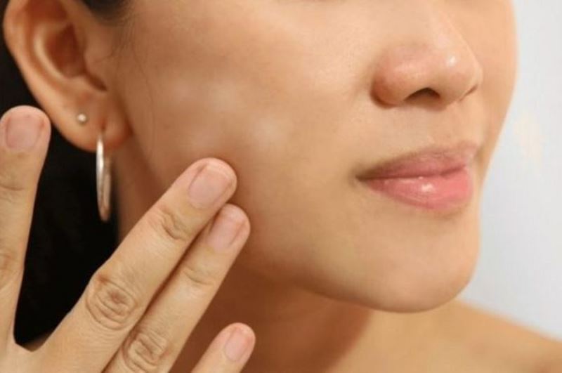 5 Bahan Alami ini Ternyata Bisa Menjadi Cara Menghilangkan Panu di Wajah Secara Cepat