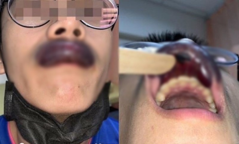 Kondisi Bibir Pria Ini Jadi Bengkak dan Mengerikan Usai Tersikut Temannya Saat Main Basket