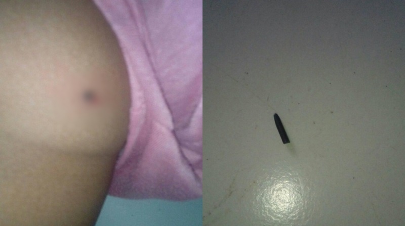 Ngeluh Sakit di Bagian Bokong Anak SD Ternyata Alami Hal Ini
