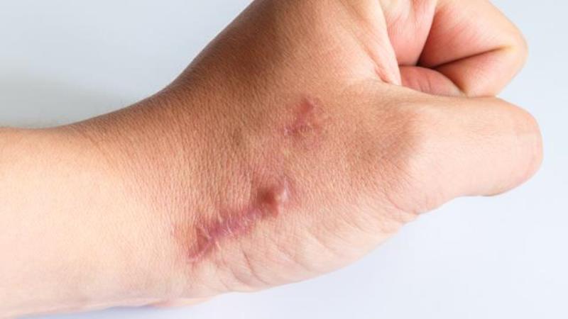 Cara Menghilangkan Keloid Secara Alami