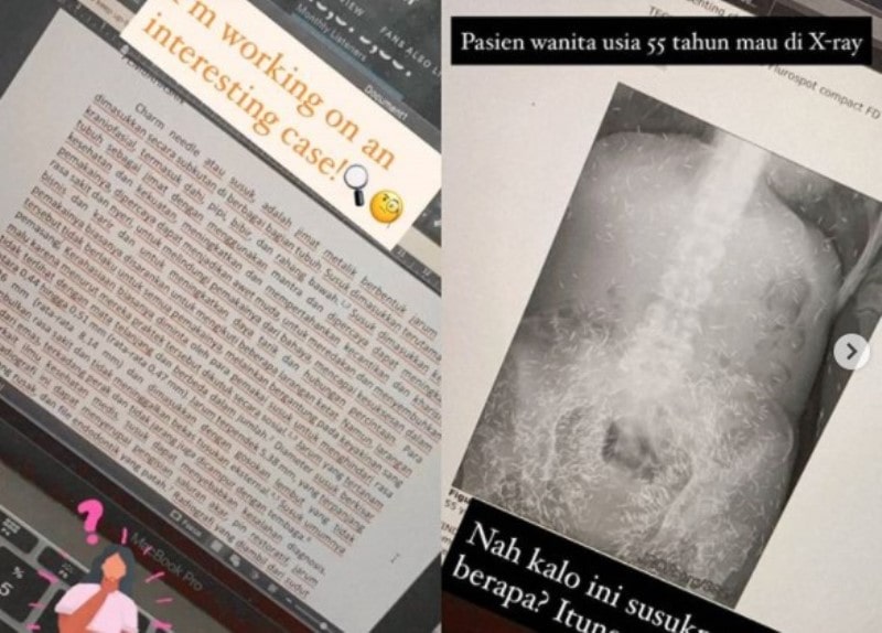 Viral Foto X ray Pasien Wanita 55 Tahun Ditemukan Ratusan Susuk di Dalam Tubuhnya