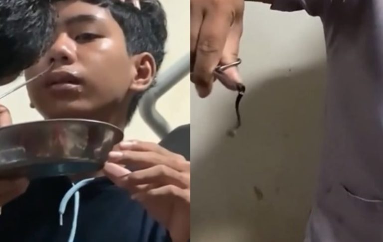 Ngeri! Ini Detik-detik Hewan Mengerikan yang Bersarang di Hidung Bocah Dikeluarkan Ngeri Ini Detik detik Hewan Mengerikan yang Bersarang di Hidung Bocah Dikeluarkan