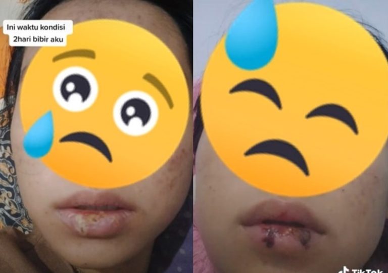 VIRAL Cerita Wanita yang Suka Mengelupasi Kulit Bibir Kini Berujung Infeksi