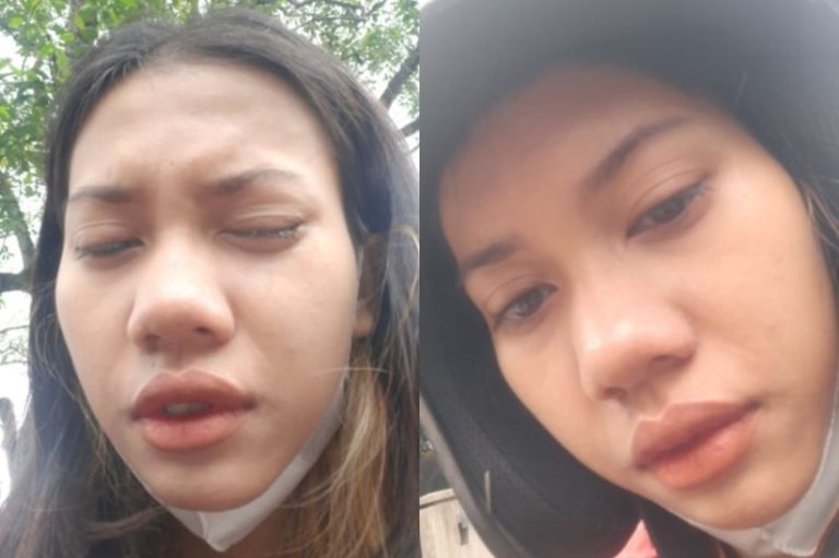 Viral Curhatan Wanita Kena Abu Rokok dari Pengendara Lain Pedih Hingga Sulit Buka Mata