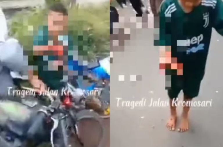 Nahas Jari Tangan Bocah di Kediri Hancur Gegara Terkena Ledakan Petasan