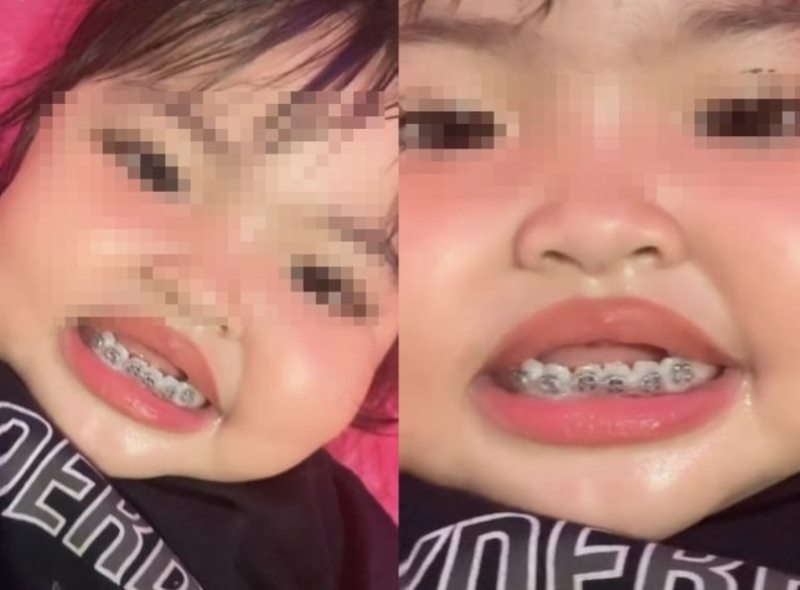 VIRAL Video Anak Balita Pakai Behel Gigi Ortunya Ramai Dikecam